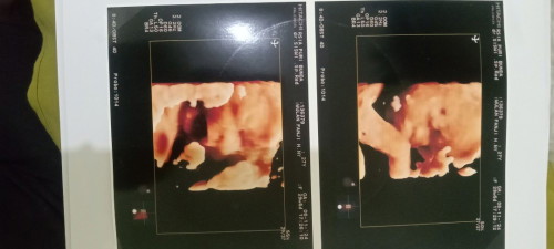 Cara baca hasil USG berat badan janin mom?? Soalnya kmrin GK ingat kira2 ada ngk yg ditulis hasil