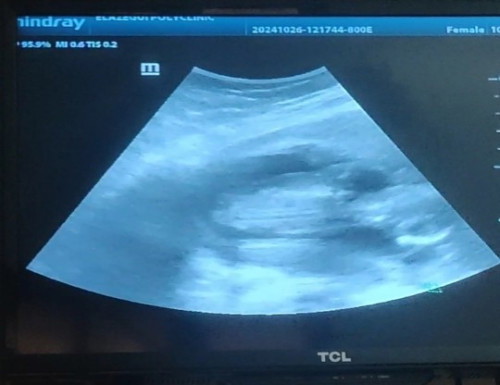 Bukol sa ultrasound ni baby