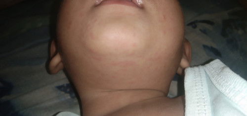 สอบถามแม่ๆ ค่ะ ตุ่มผื่นแดงๆ อะไรคะ