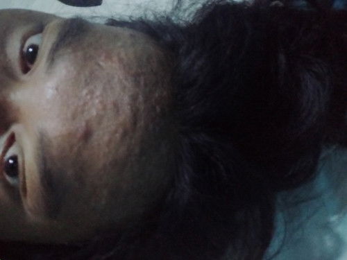 Jerawat solusinya apa