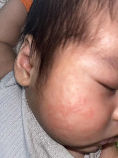 Kulit bayi merah
