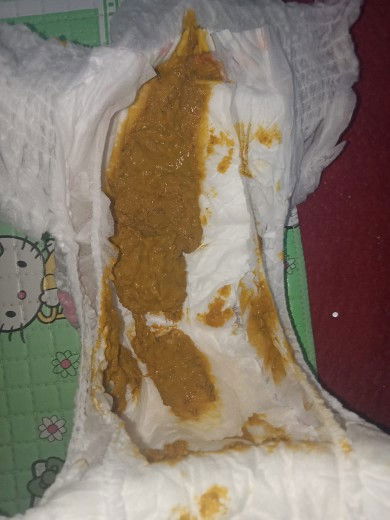 Masalah pup bayiku... Maaf atas fotonya🙏🏻