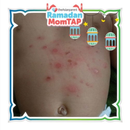 Gatal/biang keringat