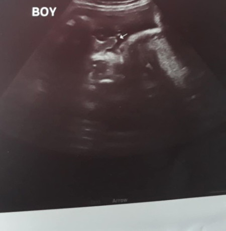 Hello po ! 35 weeks sa Pelvic Ultrasound. Boy po ba talaga? Salamat po sa sasagot.
