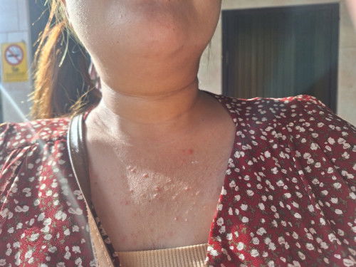 เป็นผื่นแบบนี้ตอนไตรมาส 3