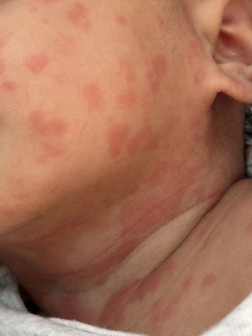 Insect bites or allergy?