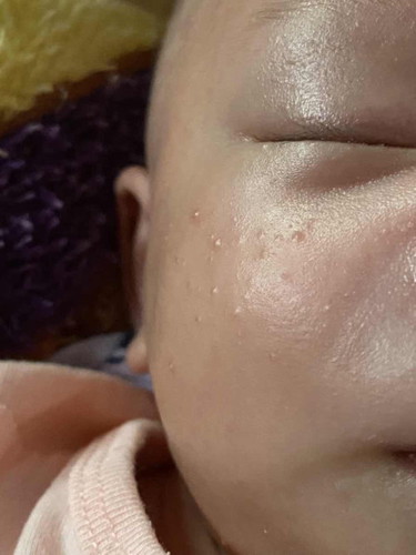 Kulit bayi newborn berbintik