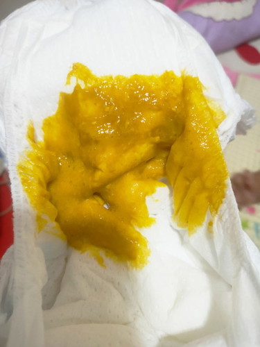 น้องอายุ 3เดือน อึแบบนี้ปกติไหม