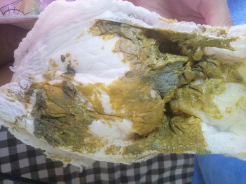 อุจจาระเเบบนี้ผฝปกติไหม