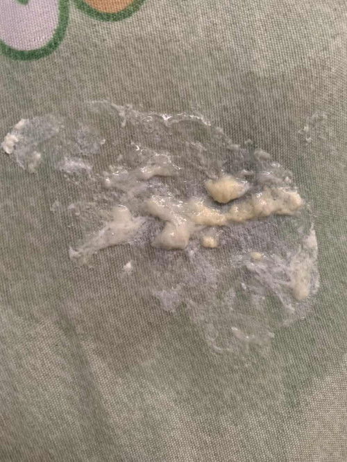 แหวะนมผิดปกติ