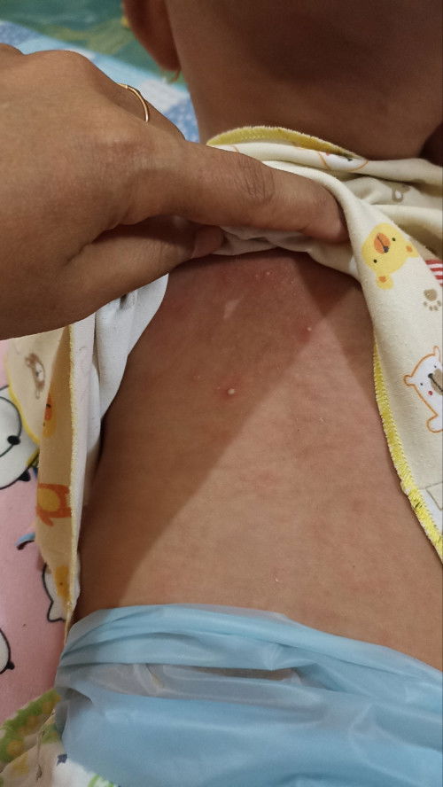 Bintik merah & nanah