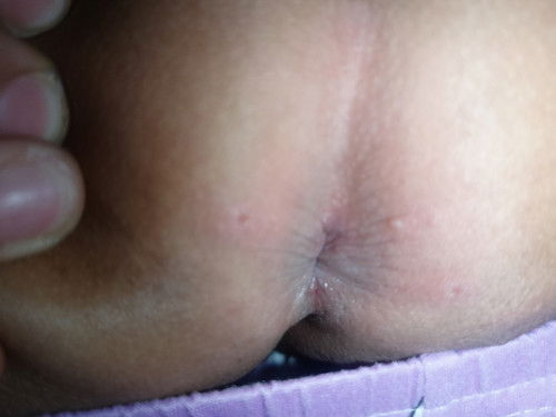 HFMD (HAND,FOOT,MOUTH,DISEASES)