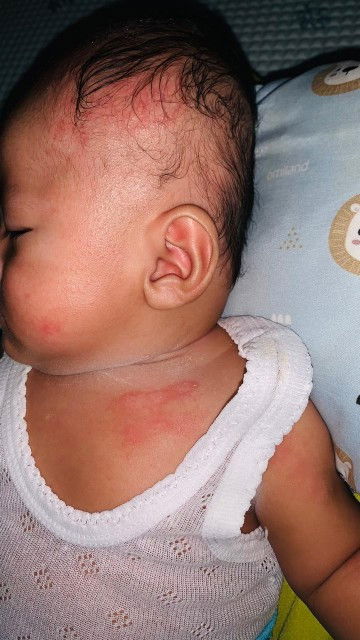 Merah dikulit bayi 3bulan