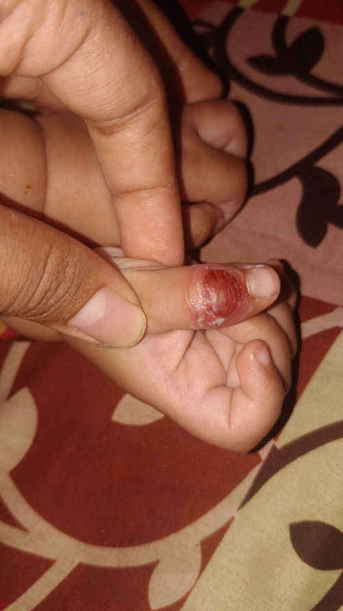 tangan berair dan ngelupas