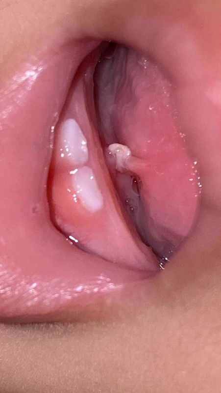 putih2 di tongue tie bayi 9 bulan