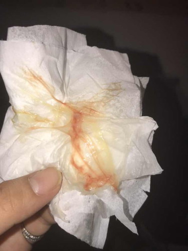 IE kaninang umaga 2cm then ngayong gabi merong discharge na ganito. Pasensya po sa pic mga mommies
