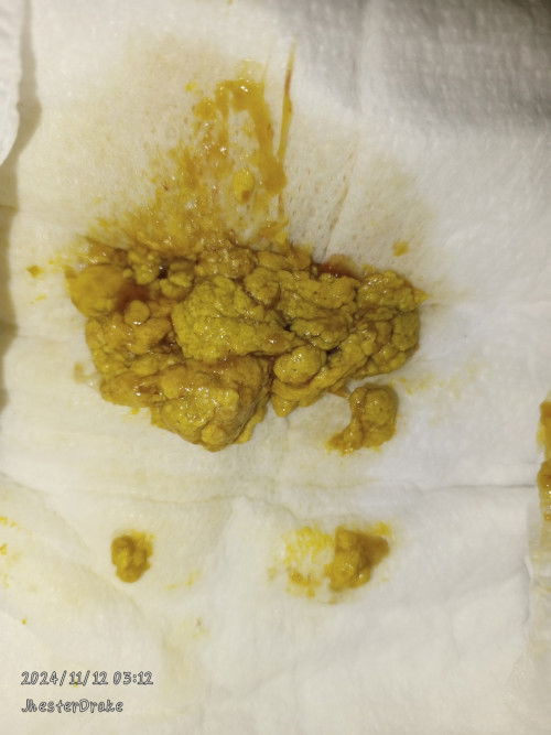 FTM 
ask ko lng po normal po ba yung may sipon sipon ang tae ni baby kaka 1month lng Nung nov2