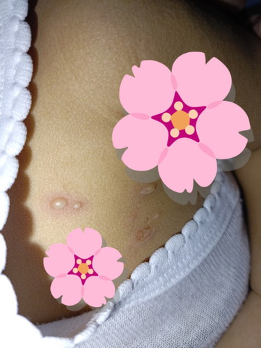 Anak usia 1 tahun bentol berair, ini kenapa ya?