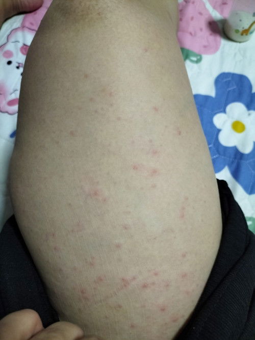 แบบนี้แพ้ยาบล๊อคหลังรึเปล่าค่ะ