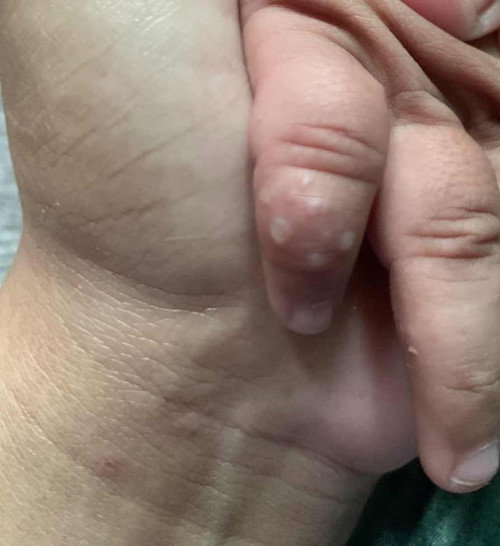 TANGAN BAYI GATAL BERISI AIR