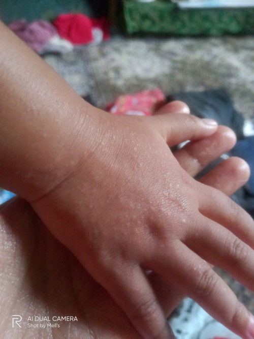 Beruntusan pada anak 4th