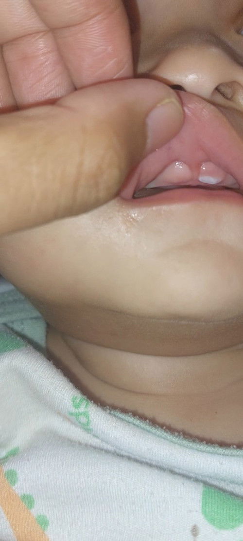 Apa ini Lip tie? harus digimanain yaa