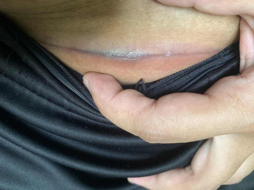 แผลผ่าคลอด1เดือน