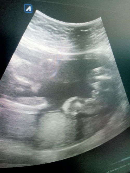 พอดีไปซาวน์ที่โรงพยาบาลไม่มีหมอเฉพาะทางแต่หมอบอกว่าน้องเป็นผู้ชายอยากทราบว่าดูจากตรงไหนค่ะ