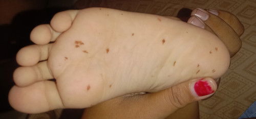 Assalamualaikum bund, 
Adakah yg punya pengalaman anak nya seperti ini? Tumbuh bercak kecoklatan..