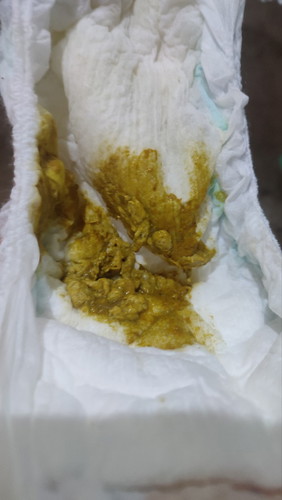 anak 1,4bulan sudah berenti asi dan lanjut minum sufor feses nya gini normal atau nggak ya bun🙏🏻