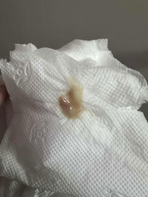 Discharge, 7weeks pregnant