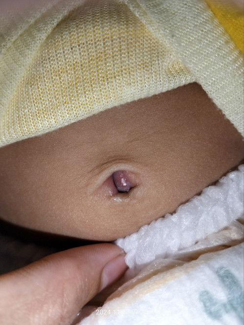 Udel, Pusar, Omphalitis, Granuloma Umbilikalis