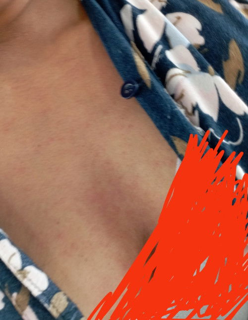 Ada yang ngamilin gak busui gatal1l2 obatnya apa ya