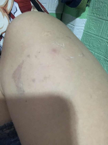 anti tetanus