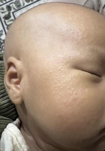ruam/bintik bintik di muka baby
