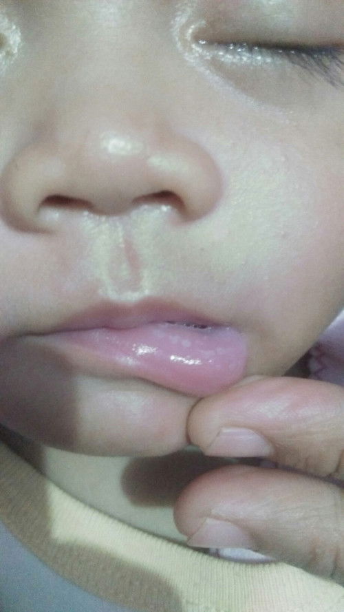 Bintik putih di bibir bayi
