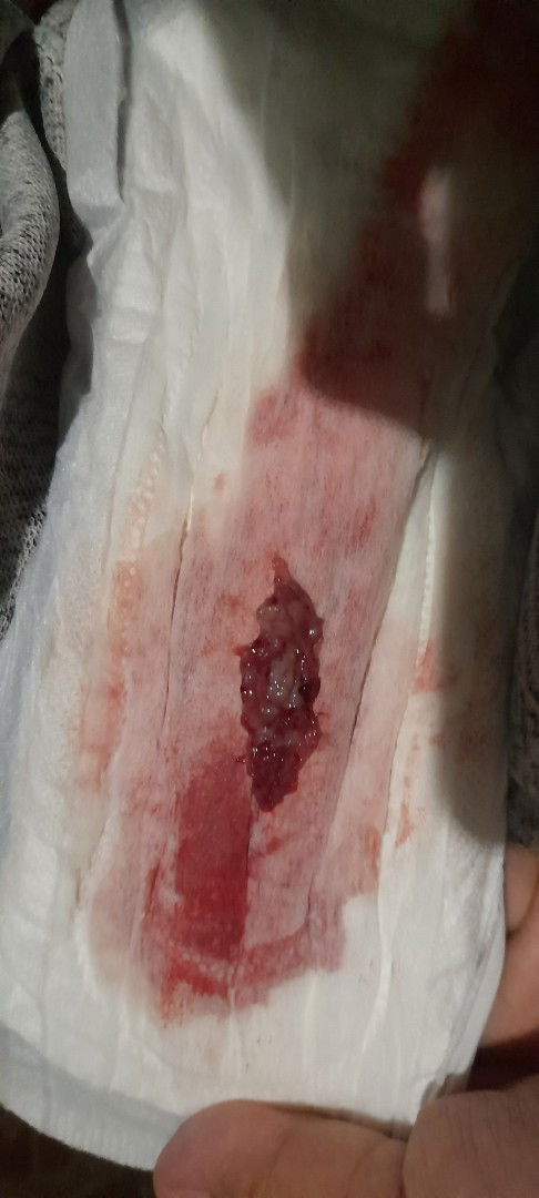 Menstruasi  setelah KB