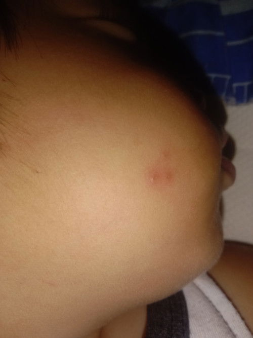 Tanong kulang po ano po to sa muka nag baby ko anong kagat po sya