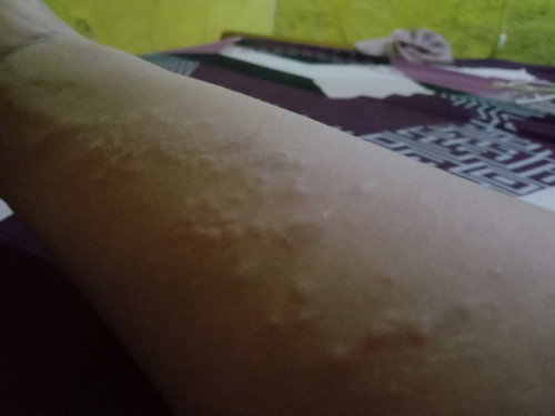 Gatal gatal di area perut dan tangan usia khamilan 7 bulan,,