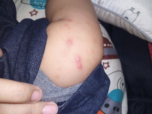 Bentol bentol merah di kulit