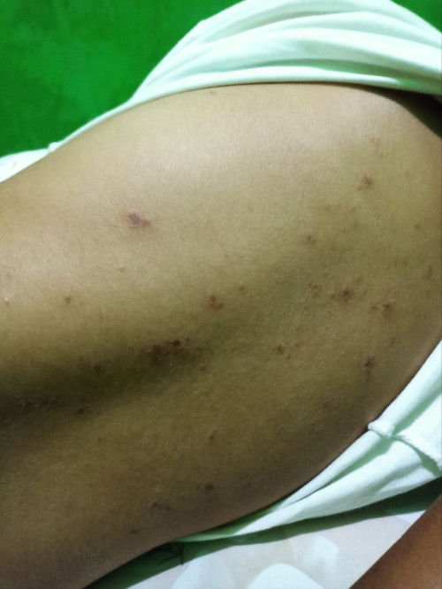 Apa penyebab ruam & gatal bagian punggung saat hamil ?