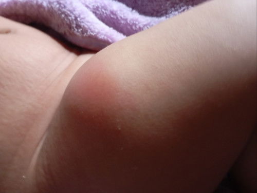 Bengkak di bekas suntikan dpt2