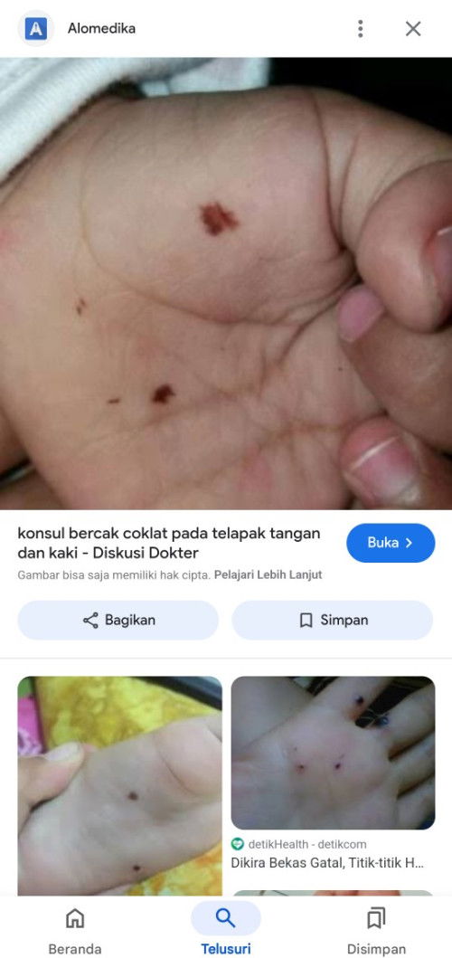 Bercak coklat pada telapak tangan bayi