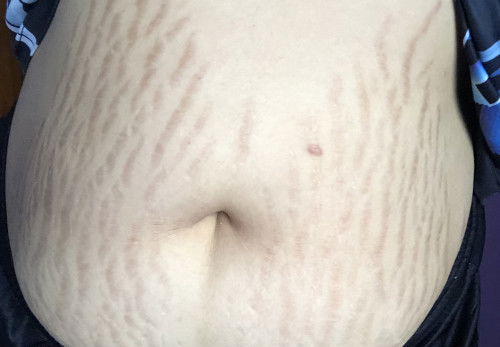 ขอวิธีช่วยลดรอยแตกลาย