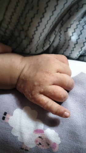 Bun ini cara ngatasinnya gimana yah?bintik kecil ber air tapi cuma di tangan