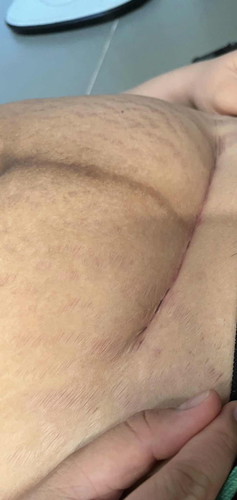 Em sinh mổ đc 20ngày mà nay vết mổ bị đỏ ko ngứa ko đau có sao ko ạ