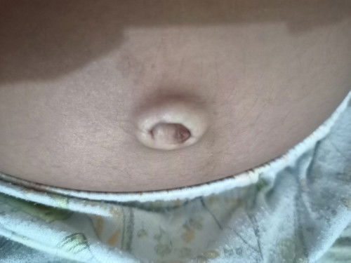 Ganito po ba talaga ang pusod ng buntis? FTM here. Pasintabi po sa larawan. Salamat.