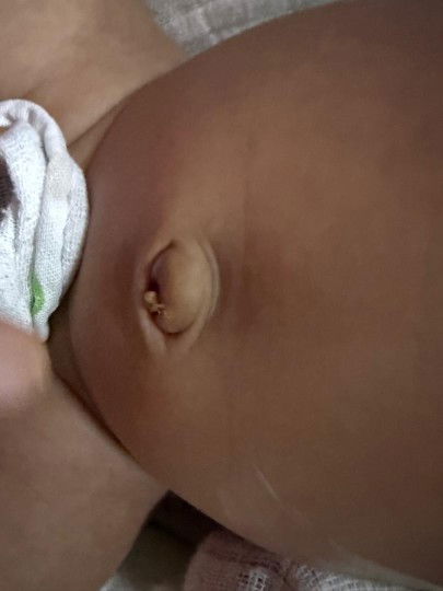 Pusat ade lebihan kulit.