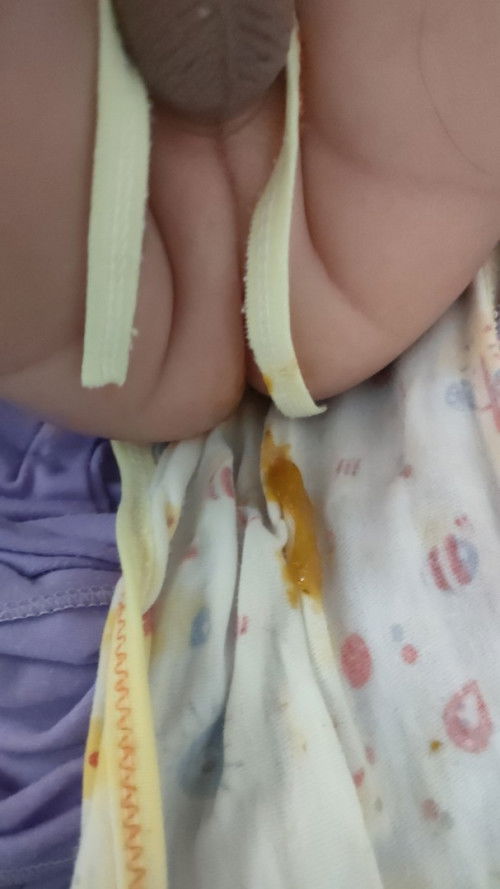 Maaf bun agak jorok, ada yg tahu ini kenapa ya? Posisi anak pilek 5harian