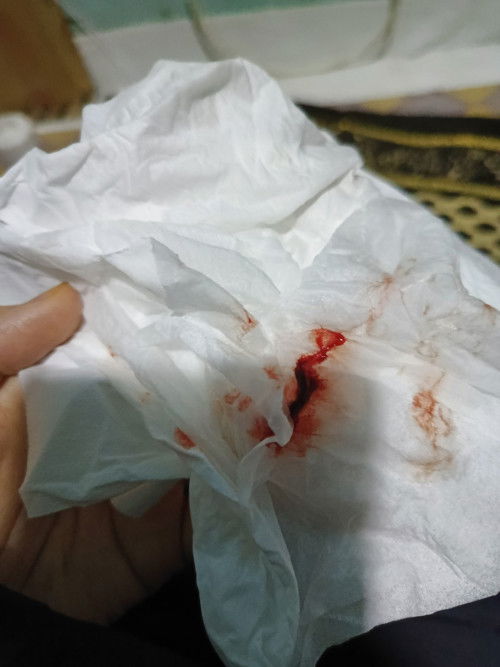 Bun kalau keluar darah dari hidung saat hamil 9 minggu itu normal ga yah? Soalnya kepikiran trs